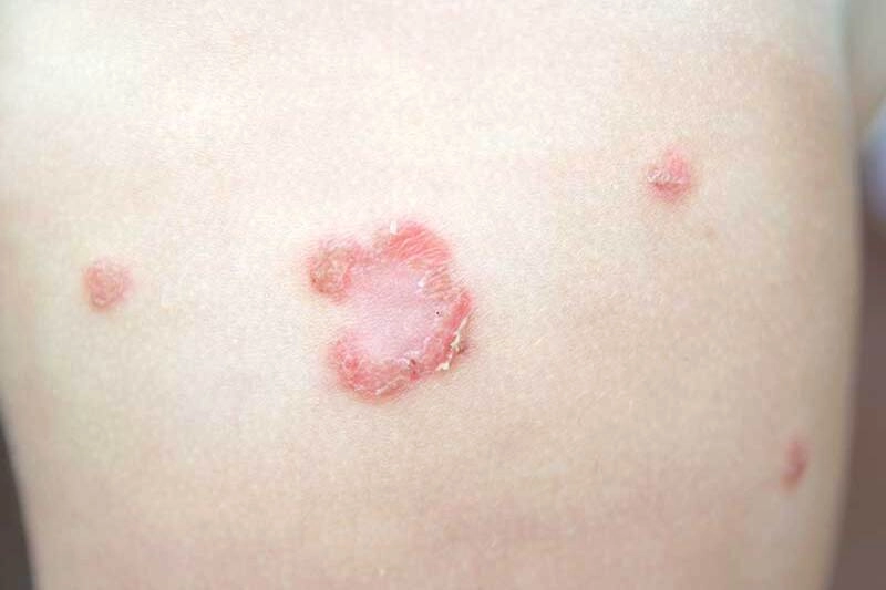 Cảnh báo từ các hình ảnh bệnh chốc lở phổ biến hiện nay