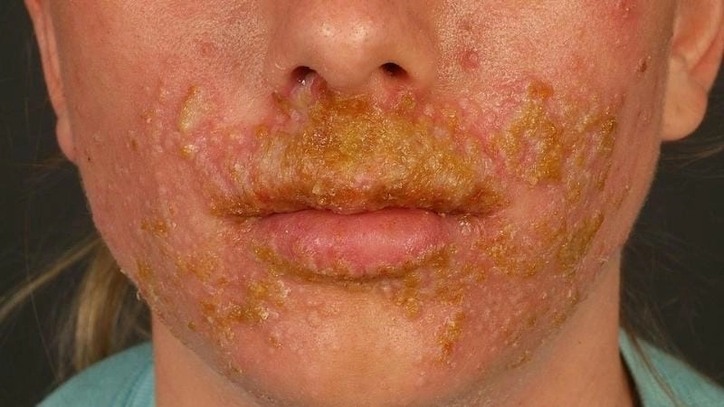 Hình ảnh bệnh chốc chân thực khi trẻ em bị chốc lở