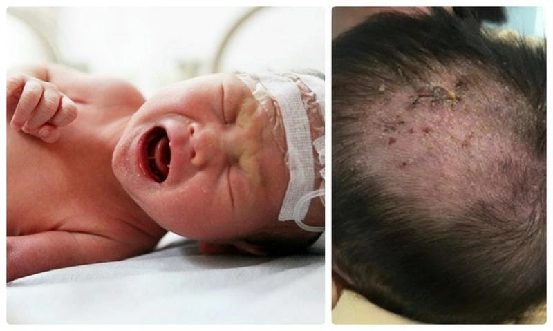 Cảnh báo qua hình ảnh bệnh chốc về bệnh chốc ở trẻ em