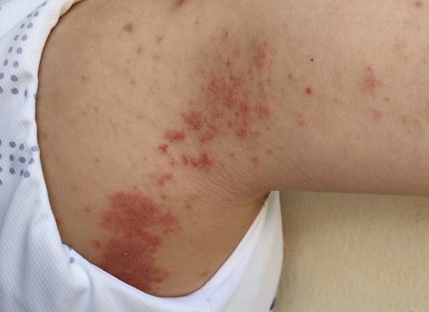 Cách nhận biết hình ảnh bệnh chốc ở trẻ em bị bệnh chốc ở trẻ