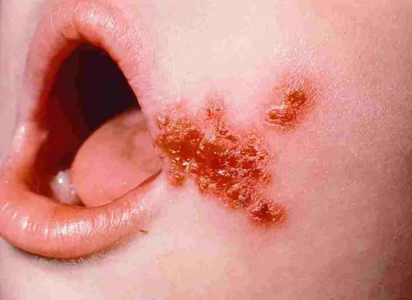 Chi tiết các hình ảnh trẻ em bị chốc lở dễ lan rộng