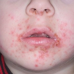 Cách phòng tránh khi trẻ em bị chốc lở ngoài da