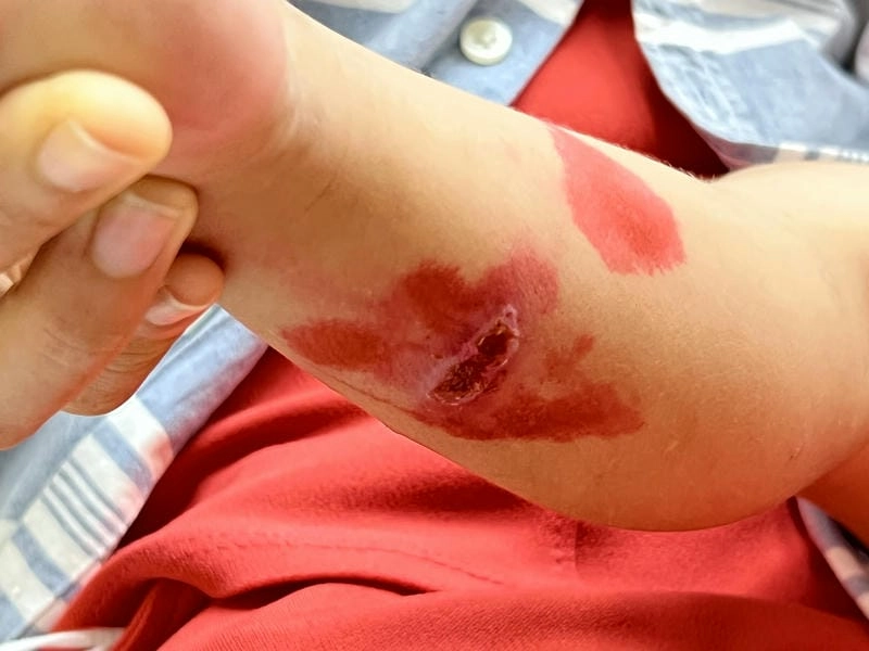 Nhận biết dấu hiệu từ bệnh chốc lở thường gặp