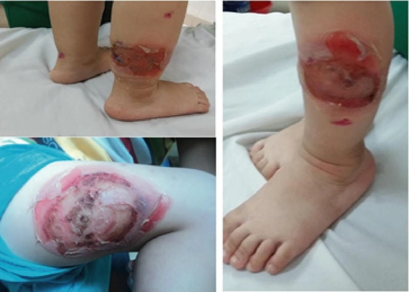 Tổng hợp hình ảnh chốc lở ở trẻ em và người lớn