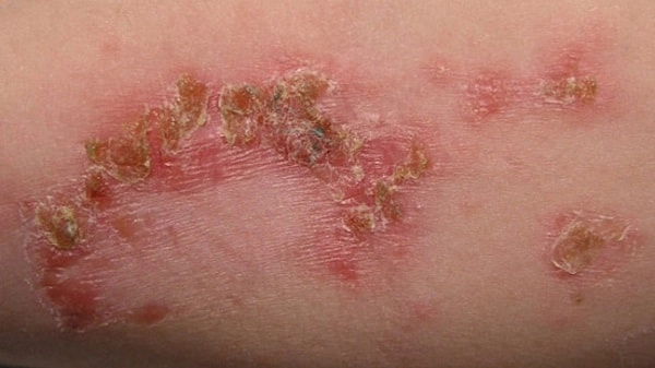 Nhận biết qua hình ảnh trẻ bị bệnh chốc lở chi tiết