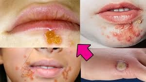 Xem rõ nét ảnh thực tế bệnh chốc lở ngoài da