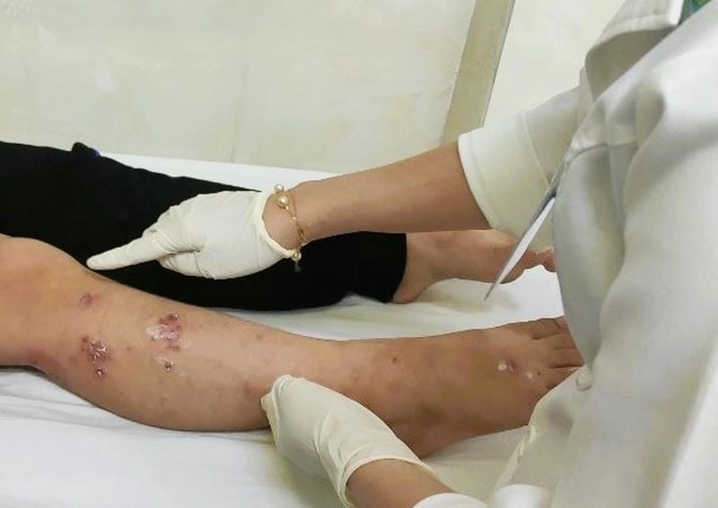 Cảnh báo qua hình ảnh người bị chốc lở thường gặp