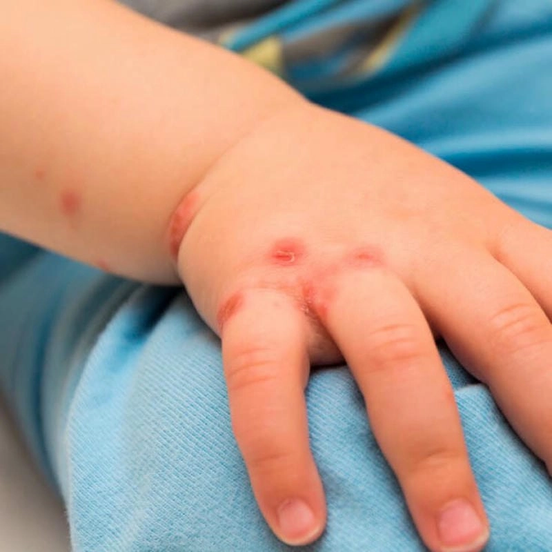 Cảnh báo sớm bệnh chốc loét ở trẻ em dễ lây