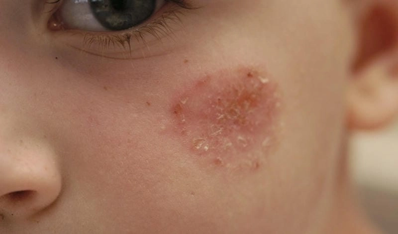 Cập nhật hình ảnh bệnh chốc lở ở trẻ em mới nhất