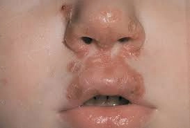 Dấu hiệu nhận biết sớm bệnh chốc da ở trẻ em