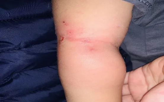 Thông tin quan trọng về bệnh chốc lở ở trẻ em