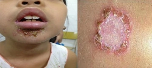 Bộ sưu tập chi tiết ảnh bệnh chốc lở thực tế