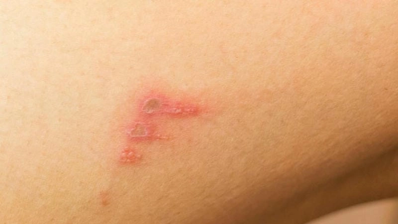 Khám phá hình ảnh bệnh chốc lở thực tế rõ nét