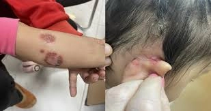 Khám phá chi tiết hình ảnh chốc lở ngoài da rõ