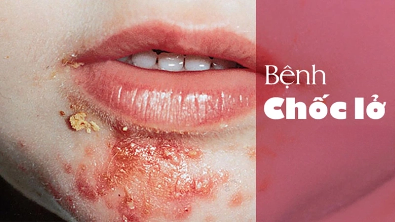 Hình ảnh bệnh chốc lở là như thế nào