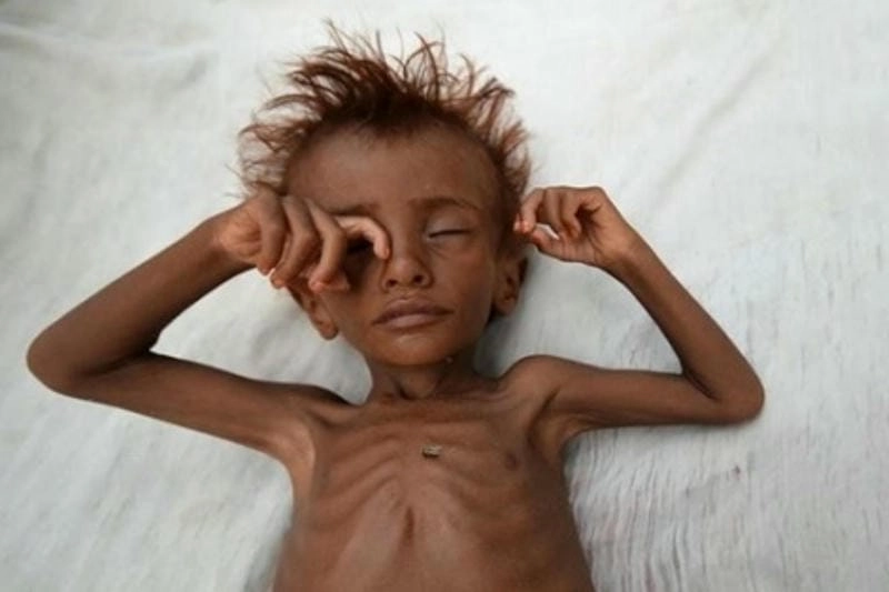 Ảnh trẻ bị còi xương phản ánh rõ biểu hiện lâm sàng