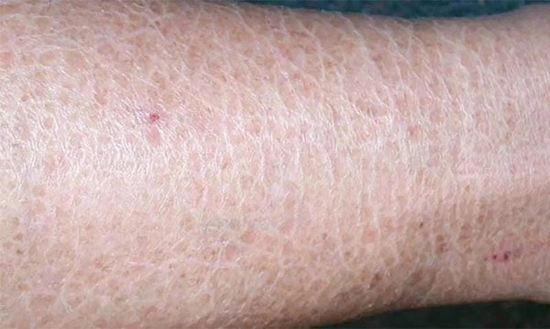 Khám phá hình ảnh bệnh da rắn chân thực rõ nét