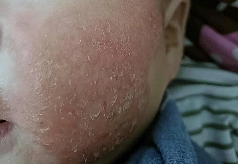 Hướng dẫn chữa bệnh da rắn ở chân nhanh chóng