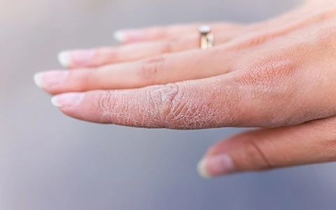 Thực trạng qua ảnh người bệnh da rắn được ghi nhận