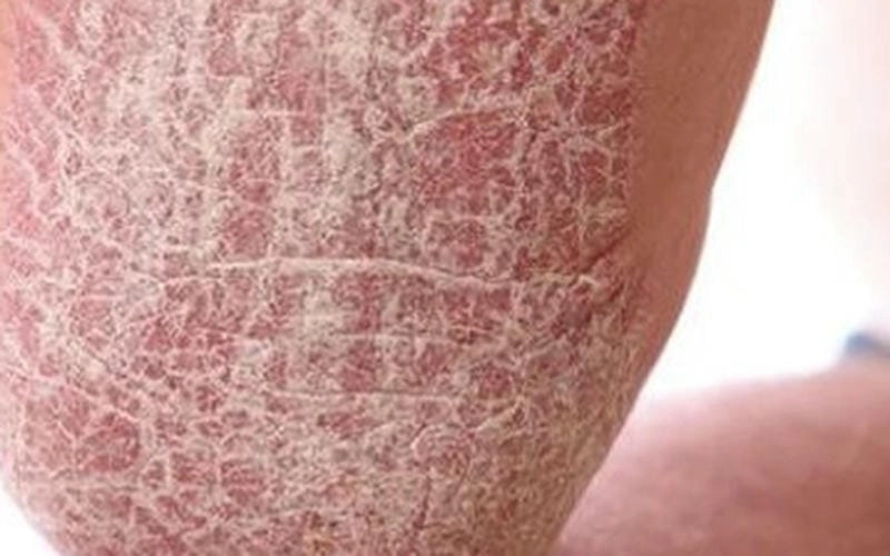 Hiệu quả thuốc chữa da rắn được kiểm chứng lâm sàng