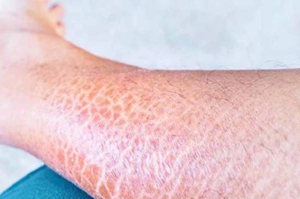 Câu chuyện thực tế về bệnh nhân bị da rắn nặng