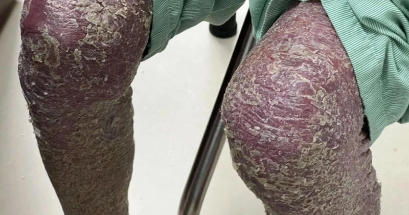 Tìm hiểu nguyên nhân và benh da ran phổ biến