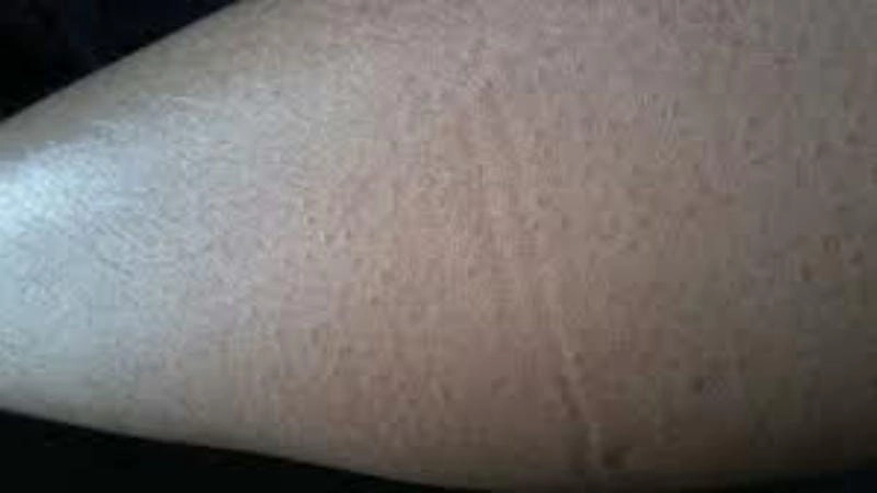 Triệu chứng bệnh da rắn ở chân dễ nhận biết