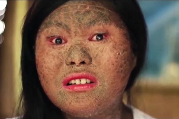 Tư liệu chân thật ảnh người bị bệnh da rắn tại viện