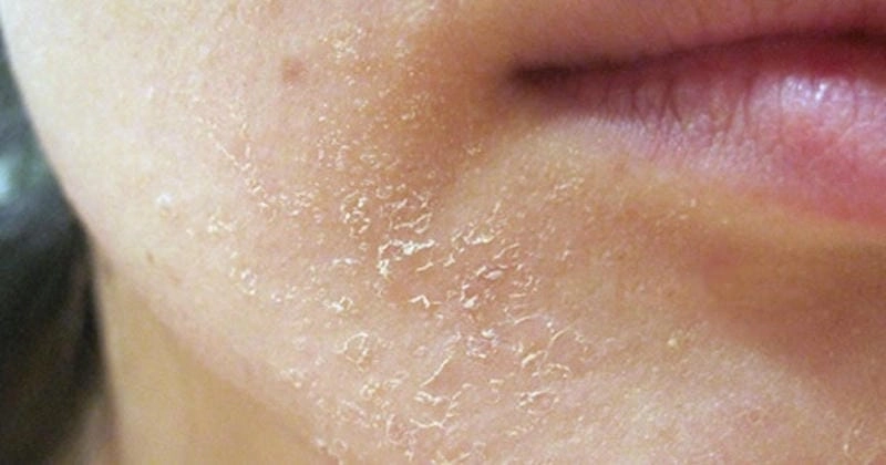 Làm gì khi cơ thể bị bệnh da rắn tiến triển nặng