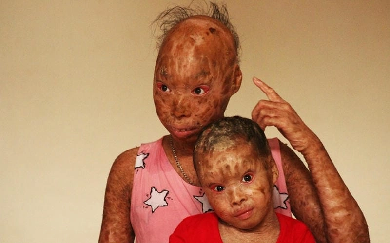 Phương pháp hiện đại chữa bệnh da rắn hiệu quả