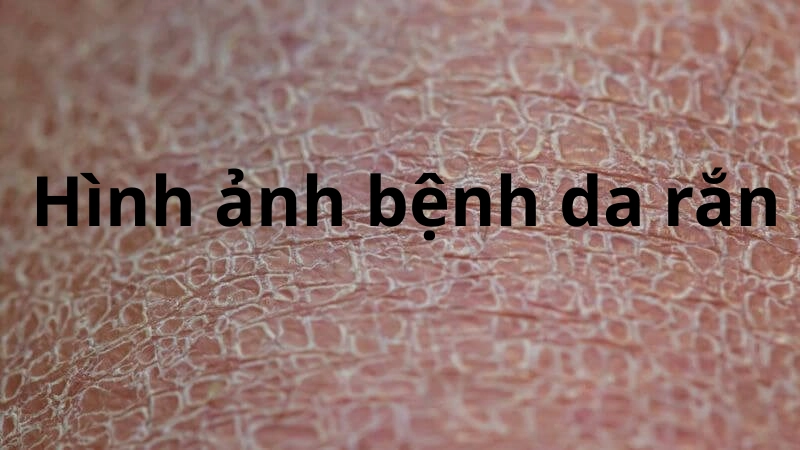 Hình ảnh bệnh da rắn là gì mà gây hoang mang