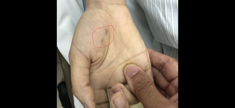 Chi tiết triệu chứng qua hình ảnh chó bị daị