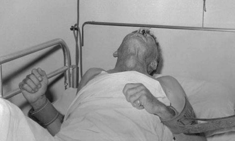 Hình ảnh thật về người bị dại giai đoạn cuối