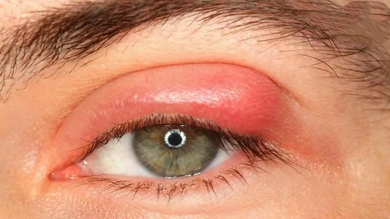 Bệnh đau mắt hột dễ lây khi tiếp xúc