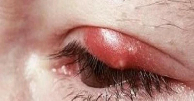 Các dấu hiệu của đau mắt hột thường bị bỏ qua