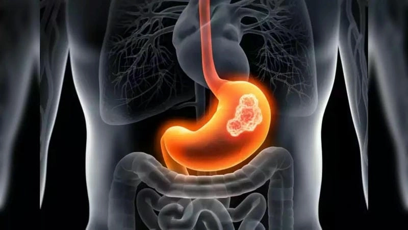 Chớ để bệnh đau dạ dày trở nặng