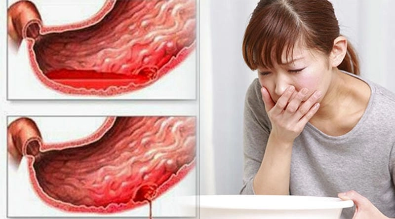 Chế độ ăn cho người bị đau dạ dày