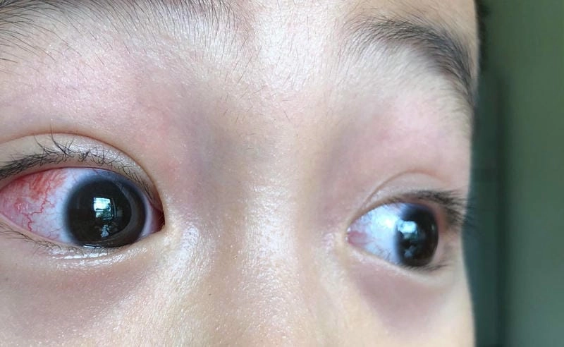 Tìm hiểu cách đau đầu ảnh hưởng đến mắt trong bệnh lý