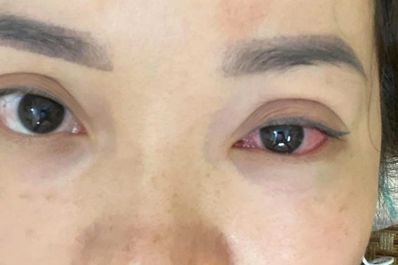 Hình ảnh bệnh đau mắt đỏ phản ánh mức độ viêm nhiễm