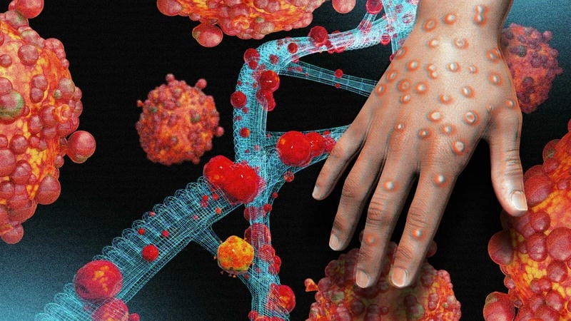 Khám phá hình ảnh bệnh đậu mùa khỉ chân thực rõ nét