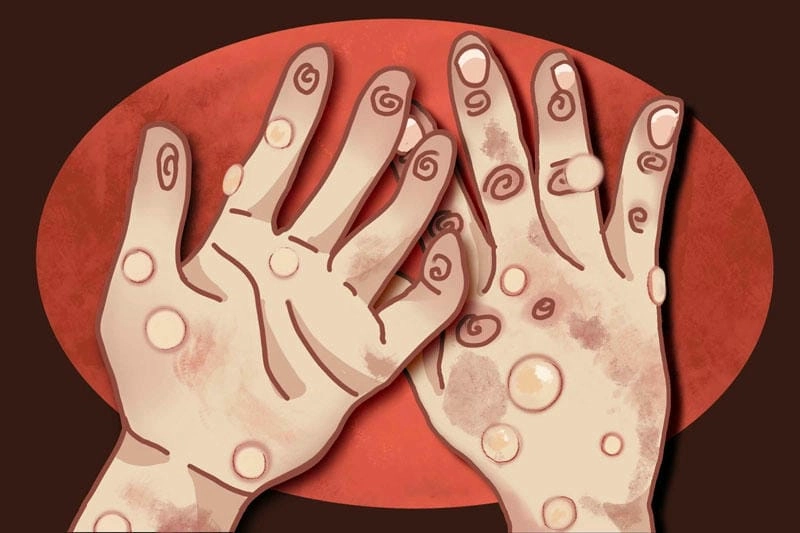 Bộ sưu tập hình bệnh đậu mùa khỉ chuẩn y khoa