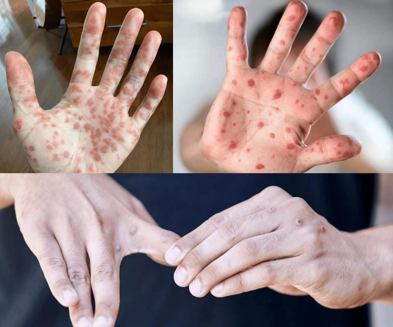 Cảnh báo cộng đồng qua hình ảnh bị đậu mùa khỉ chân thực