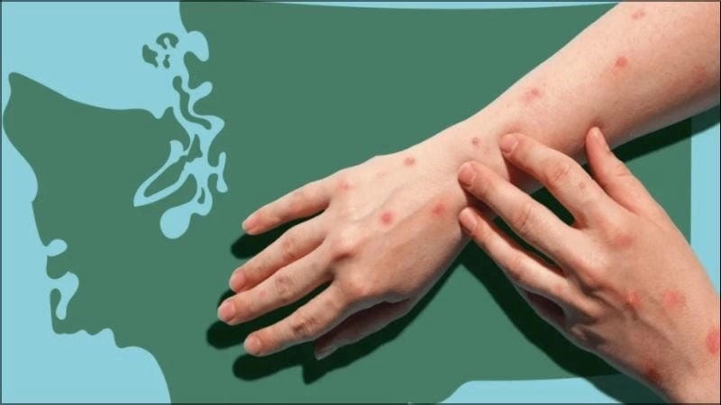 Theo dõi hình ảnh dịch đậu mùa khỉ từ cơ quan y tế