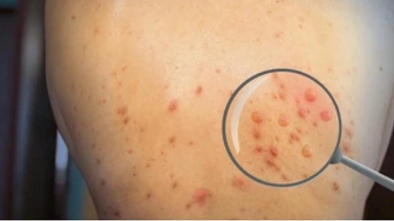 Tìm hiểu ảnh đậu mùa khỉ để nhận biết sớm bệnh