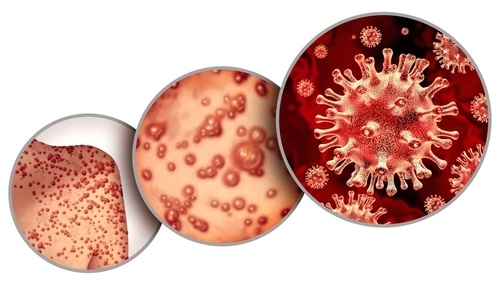 Bộ sưu tập ảnh bệnh đậu mùa chân thực cảnh báo bệnh