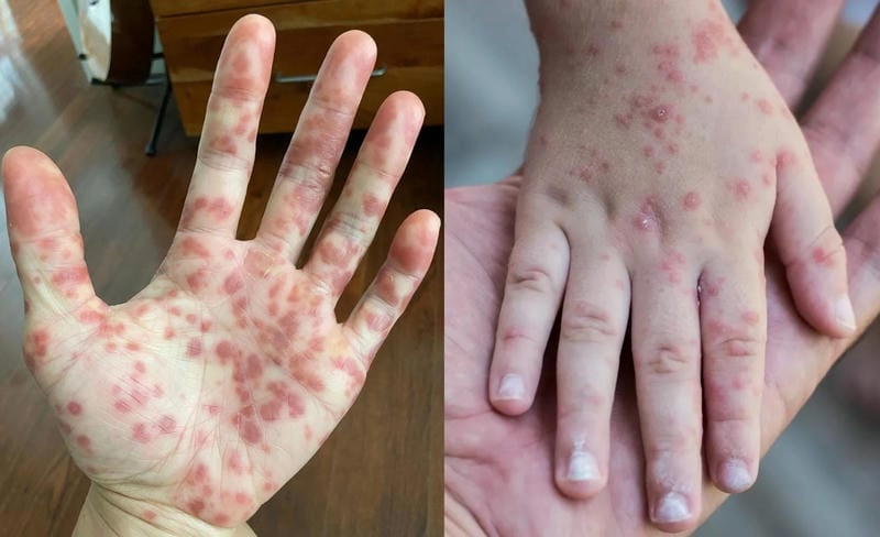 Hình ảnh minh họa triệu chứng đậu mùa khỉ dễ nhận biết