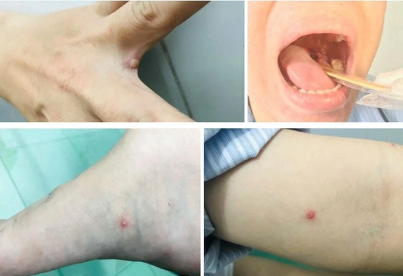 Tìm hiểu dấu hiệu của bệnh đậu mùa khỉ qua hình ảnh