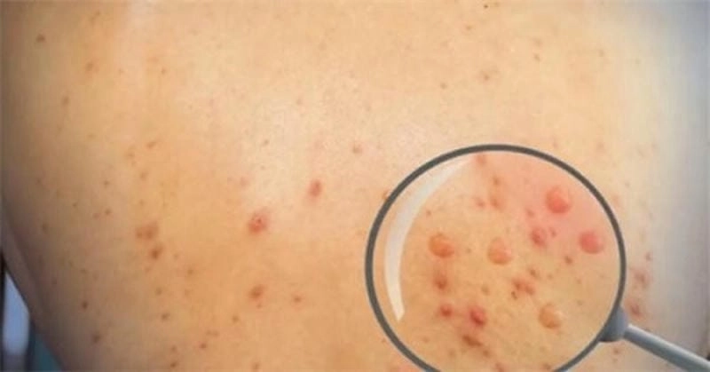 Khám phá hình đậu mùa khỉ chân thực rõ nét