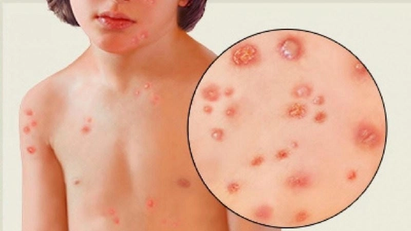 Xem chi tiết hình ảnh bệnh đậu mùa chân thực từ ảnh bệnh đậu mùa
