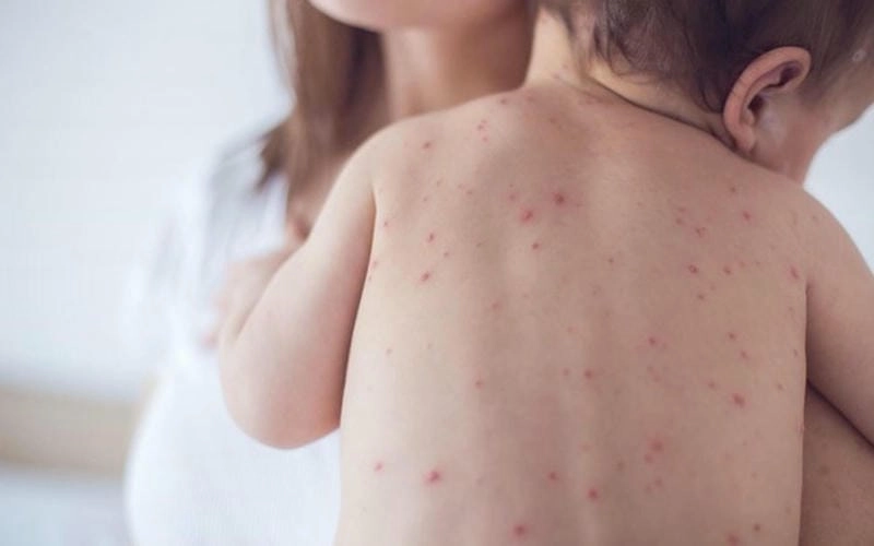 Tìm hiểu rõ hơn hình ảnh bệnh đậu mùa thông qua ảnh đậu mùa khỉ